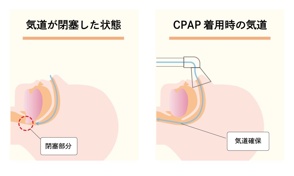 CPAP